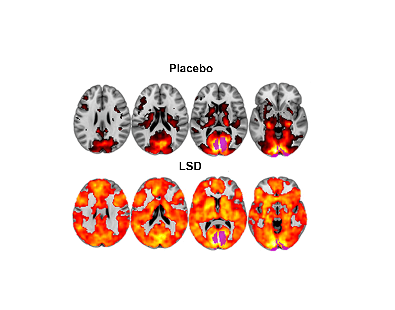 /media/glv6dc/LSD-Brain-Imaging-Study-2.png